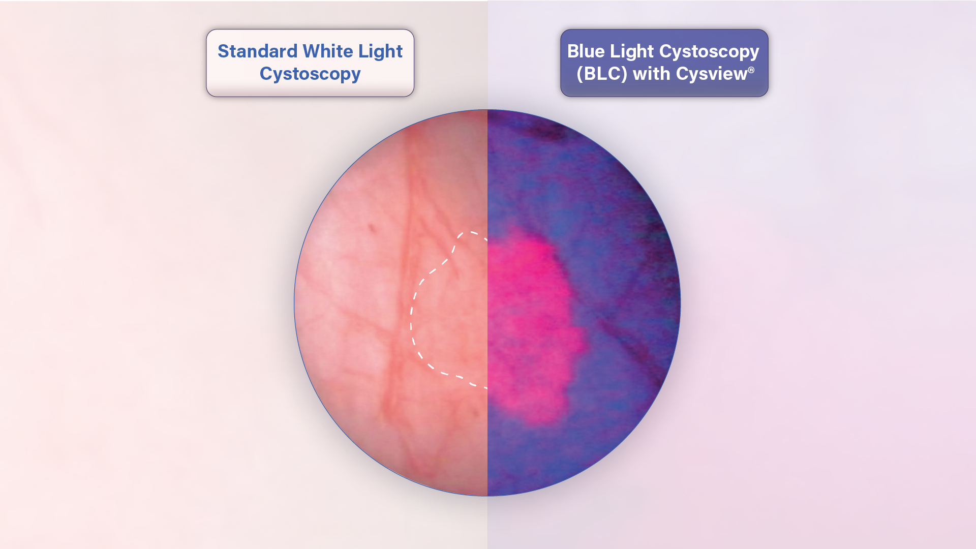 Bladder Cancer Diagnosis Roswell Park Comprehensive Cancer Center