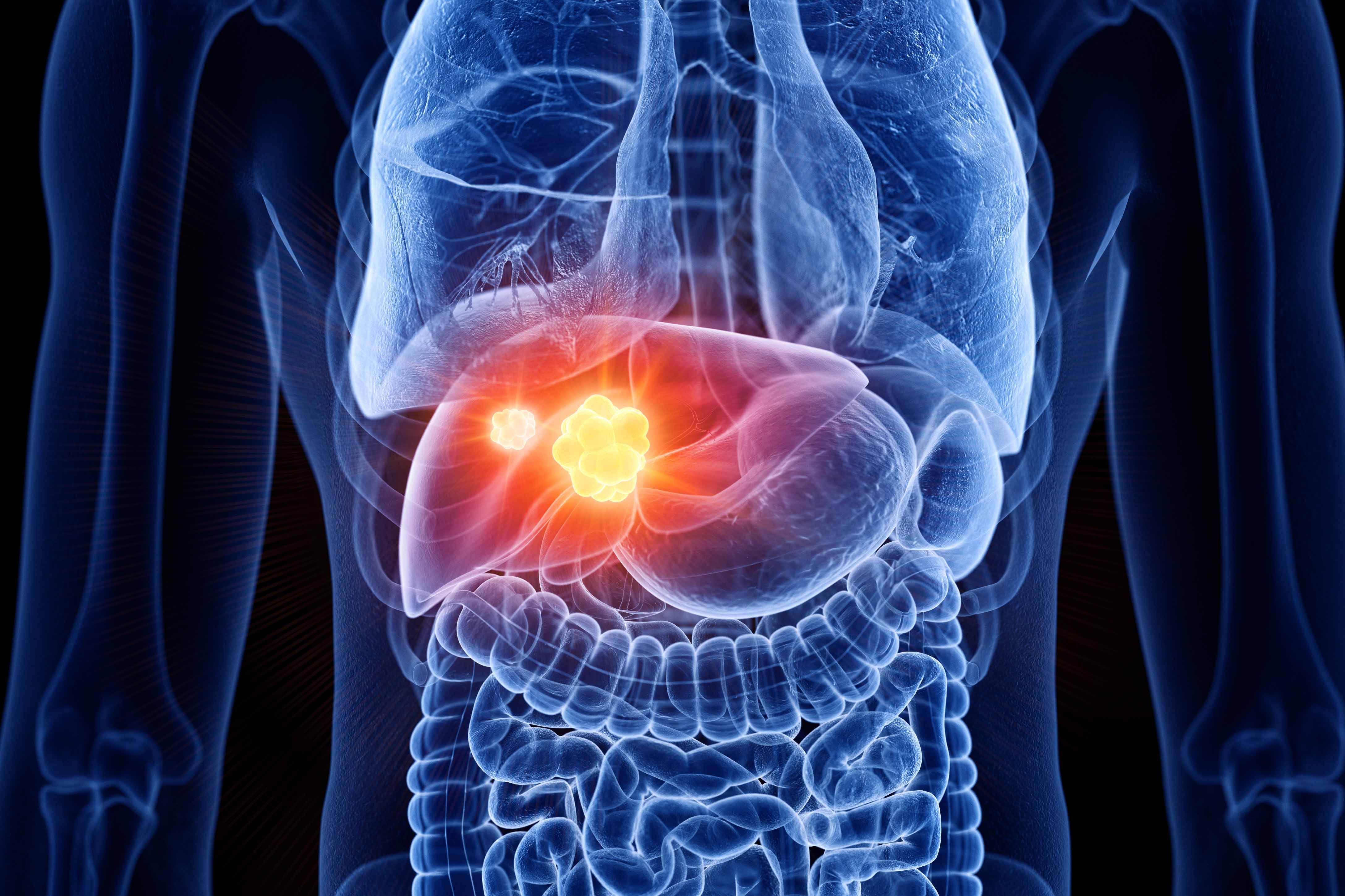 Fatty Liver Disease And The Link To Liver Cancer Roswell Park 