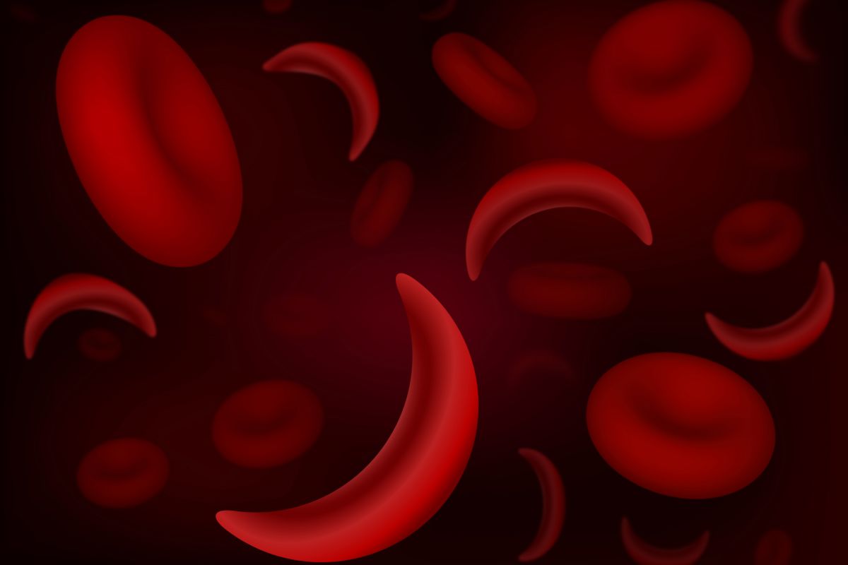 What Is Sickle Cell Disease? Roswell Park Comprehensive