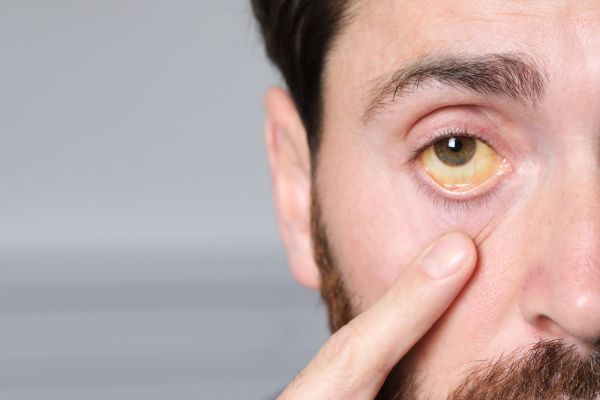 Close up of a man's eye with a yellow tint caused by jaundice