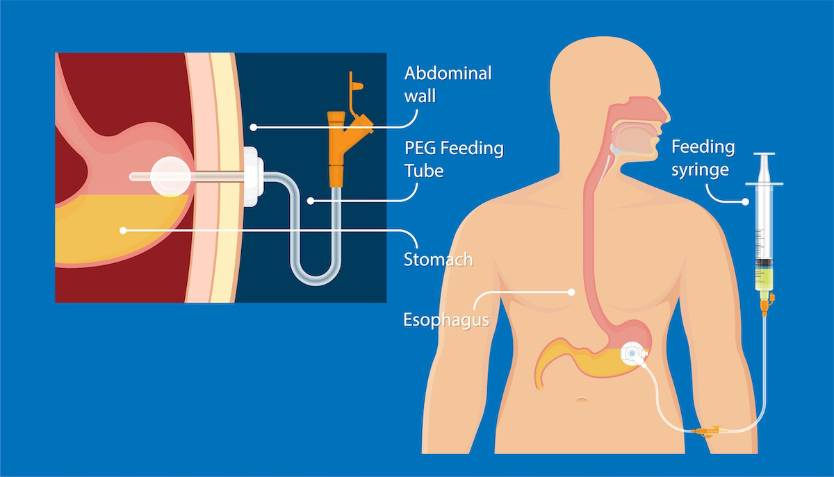 Feeding Tubes What You Should Know Roswell Park Comprehensive   Adobestock 327193407 