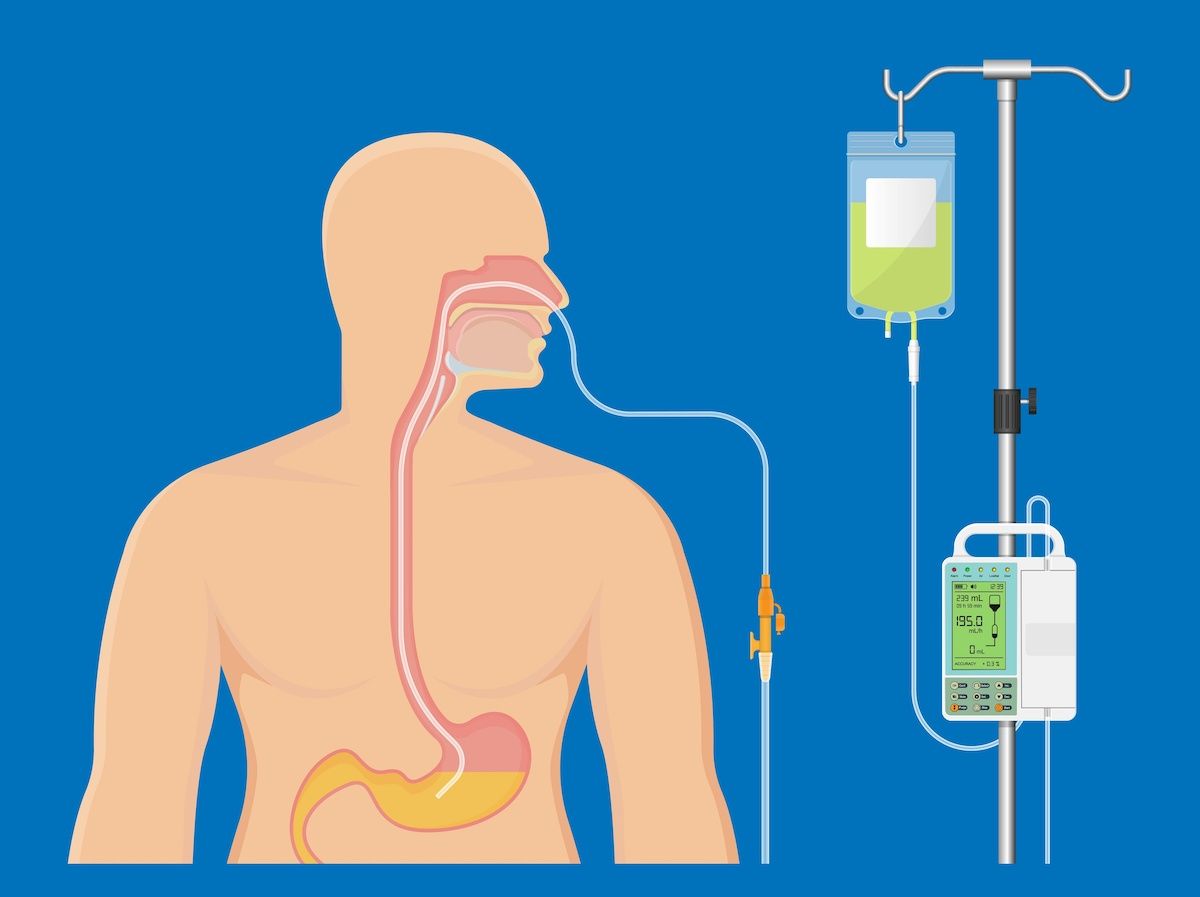 Feeding Tubes — What You Should Know | Roswell Park Comprehensive ...