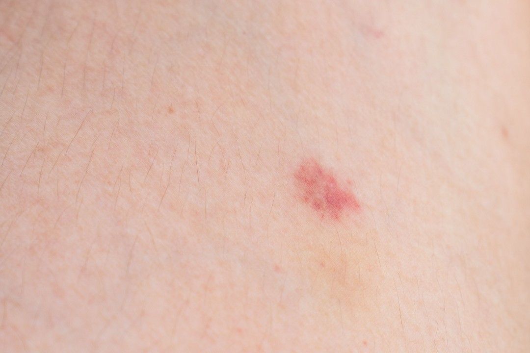 Red Spots  Complete Dermatology