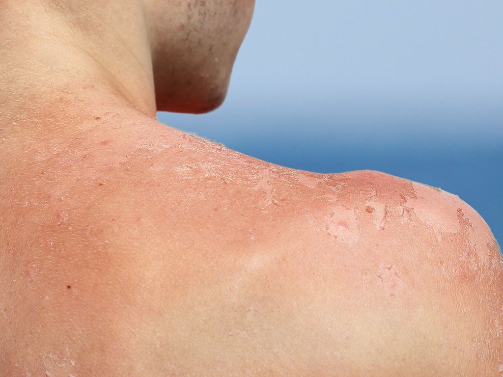 Can you prevent skin cancer after a bad sunburn Roswell Park