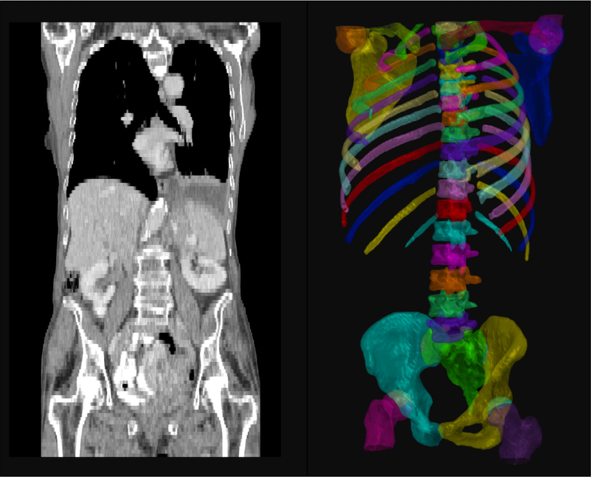 CT scan and skeletal image of an abdomen