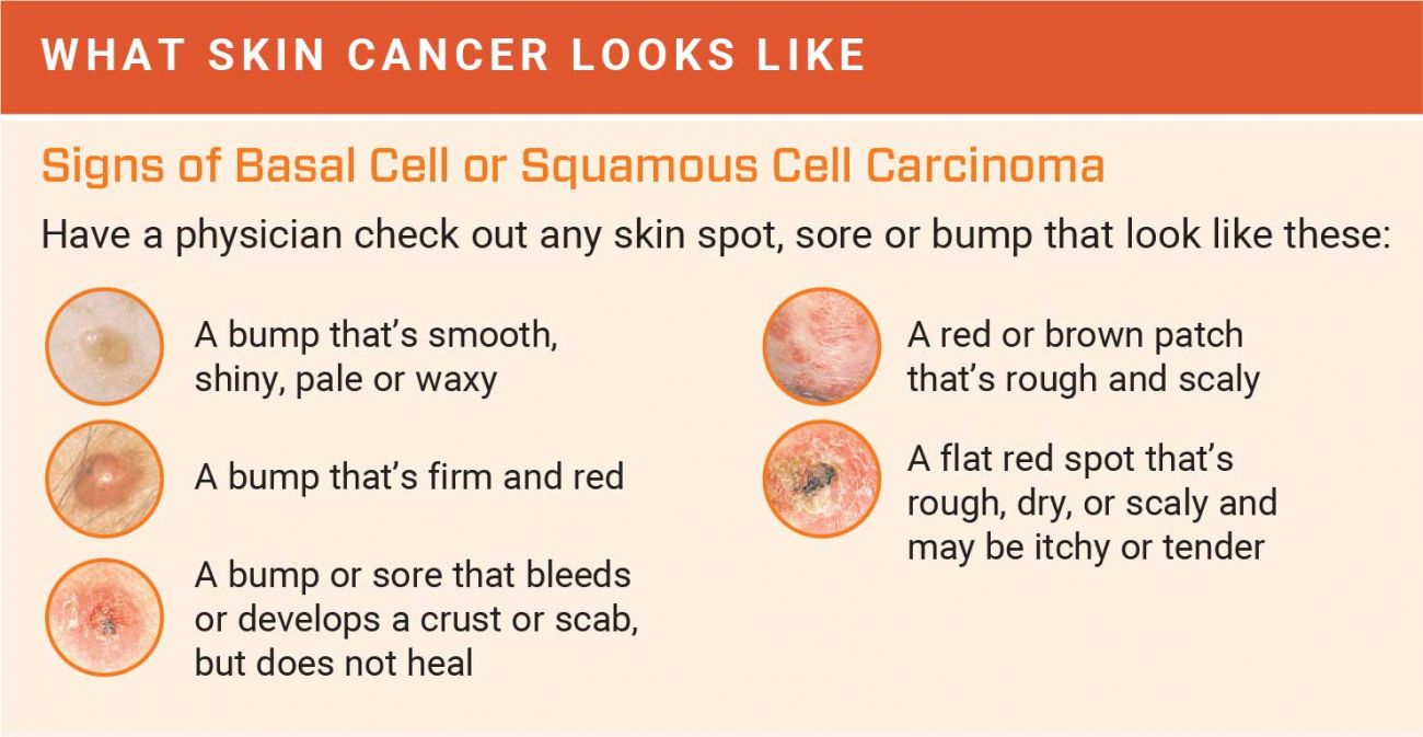 research questions about skin cancer