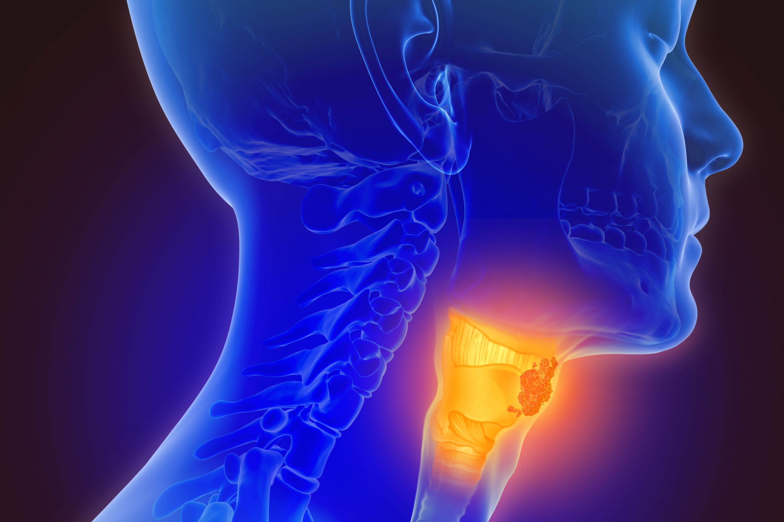 What Does Throat Cancer Feel Like? Roswell Park Comprehensive Cancer