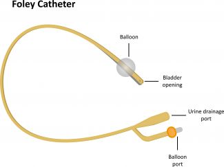 What's A Foley Catheter? | Roswell Park Comprehensive Cancer Center ...