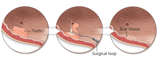 Transurethral Resection Of The Bladder