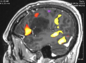 Low Grade Glioma Roswell Park Comprehensive Cancer Center