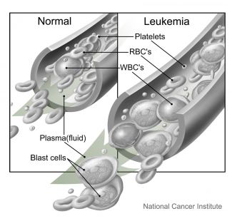 bone marrow diagram leukemia
