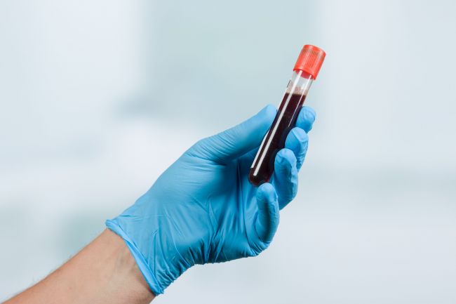 Frequently Asked Questions about the PSA Blood Test | Roswell Park ...