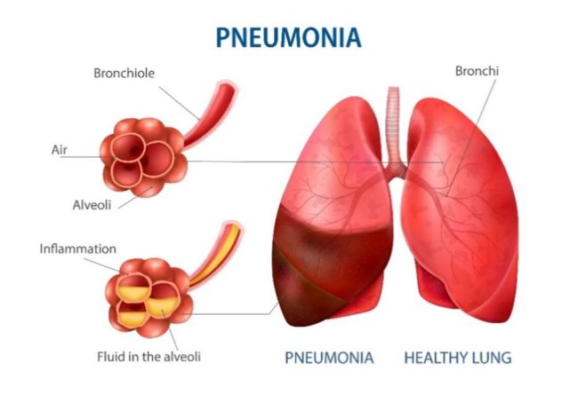 Preventing pneumonia | Roswell Park Comprehensive Cancer Center ...