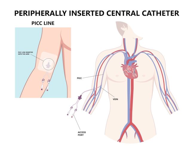 What is a PICC line? | Roswell Park Comprehensive Cancer Center ...