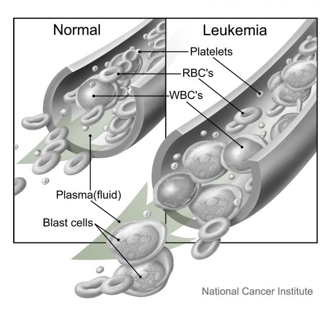 What Is Leukemia? Roswell Park Comprehensive Cancer Center Buffalo, NY